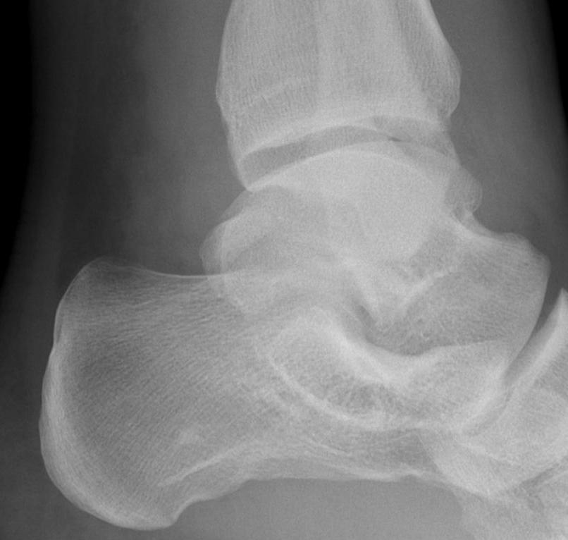 Talus Posterior Process Fracture